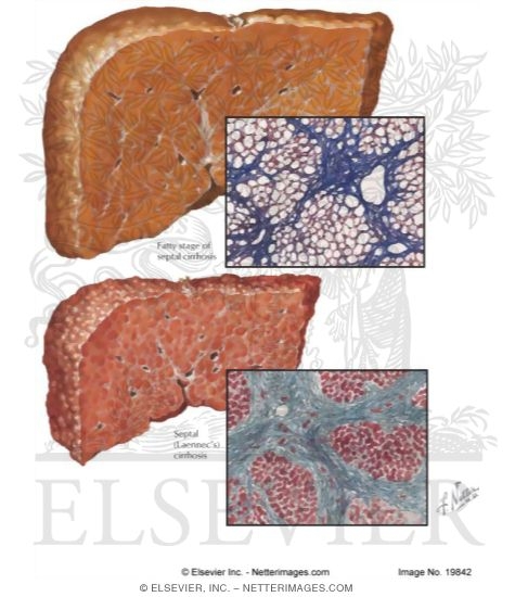 Watermarked preview of labeled image: Nutritional Liver Diseases
