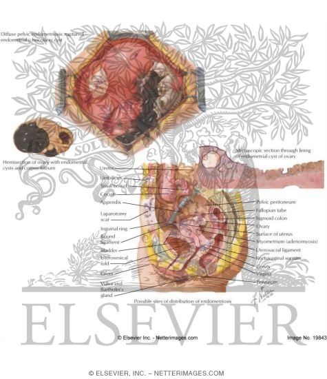 Watermarked preview of labeled image: Endometriosis II - Pelvis