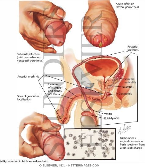 prostatit urethritis