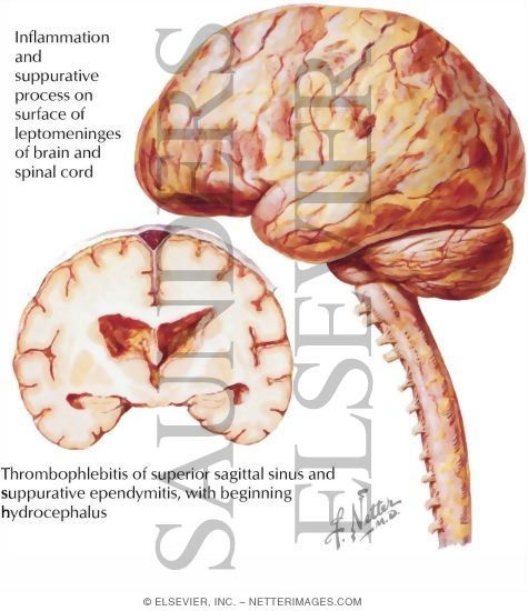 Purulent and Bacterial Meningitis