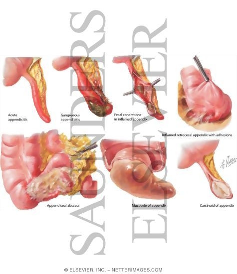 Diseases of the Appendix: Inflammation, Mucocele, Tumors