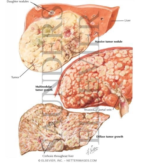 Tumors II - Primary Hepatic Carcinoma