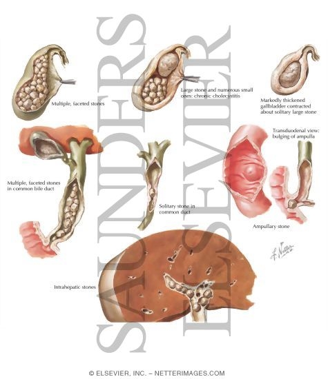Watermarked preview of labeled image: Cholelithiasis III - Pathologic Features, Choledocholithiasis