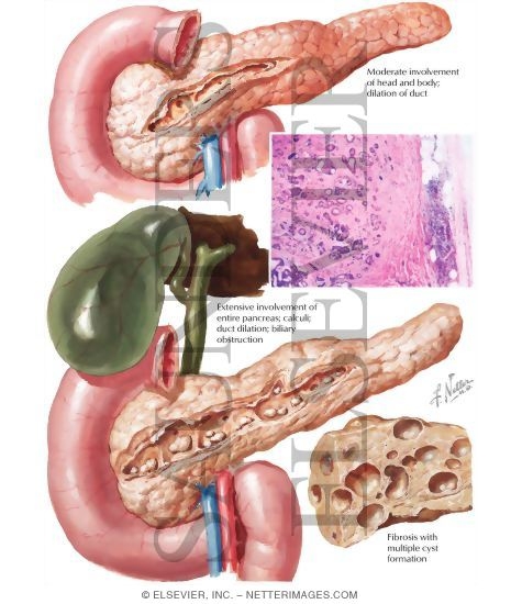 Watermarked preview of labeled image: Chronic (Relapsing) Pancreatitis