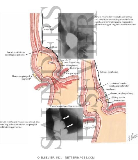 Inferior Esophageal Ring Formation