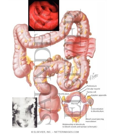 Watermarked preview of labeled image: Diverticulosis   