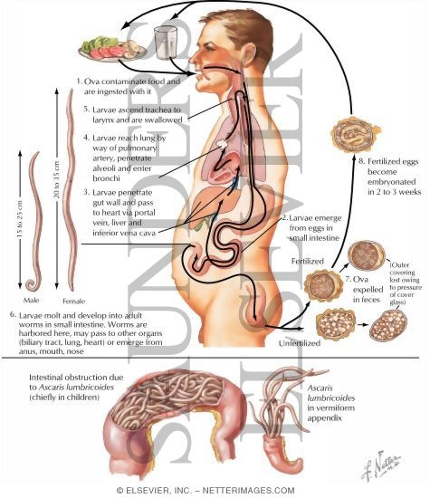 Watermarked preview of labeled image: Parasitic Diseases II - Ascariasis