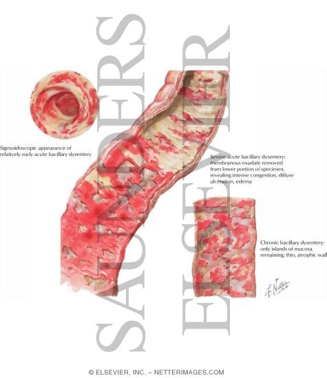 Watermarked preview of labeled image: Bacillary Dysentery
