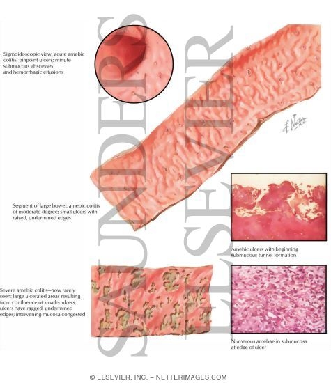 Watermarked preview of labeled image: Amebiasis
