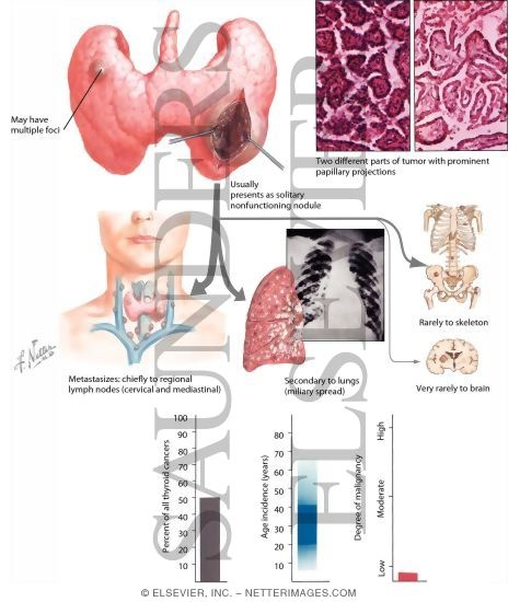 Watermarked preview of labeled image: Papillary Carcinoma of the Thyroid