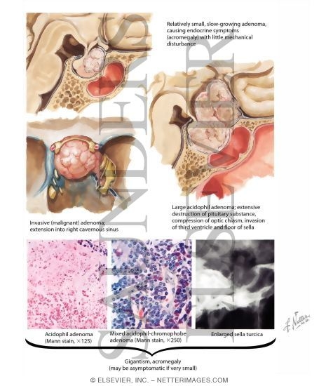 Watermarked preview of labeled image: Acidophil Adenoma