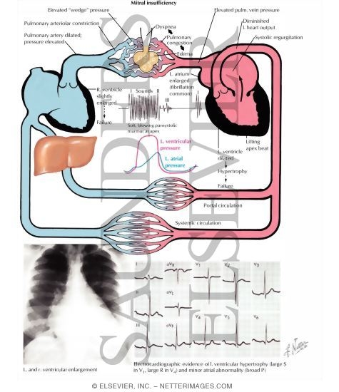Mitral Insufficiency Pathophysiology and Clinical Aspects of Mitral