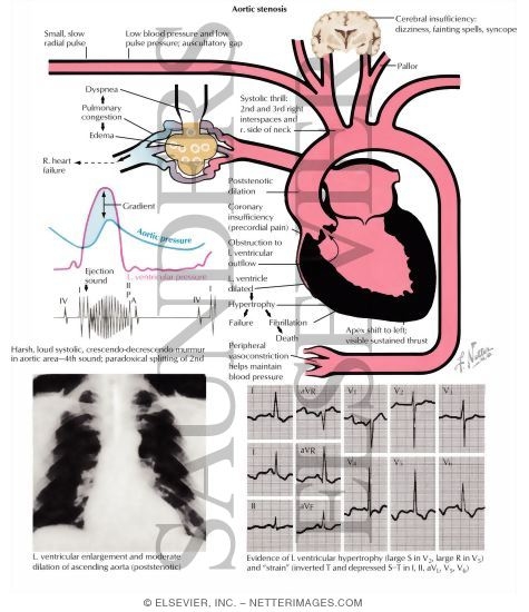 Aortic Stenosis