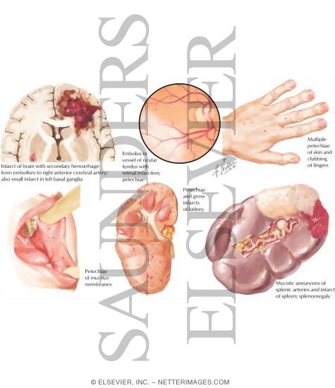 Watermarked preview of labeled image: Bacterial Endocarditis - Remote Embolic Effects