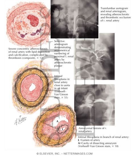 Watermarked preview of labeled image: Occlusive Disease of Main Renal Artery