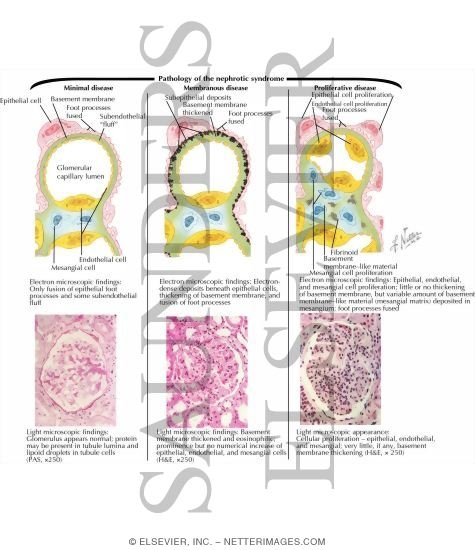 Watermarked preview of labeled image: Pathology of the Nephrotic Syndrome