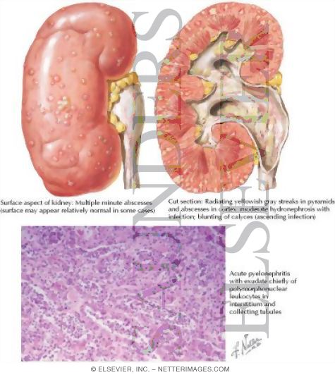 Acute Pyelonephritis: Pathology