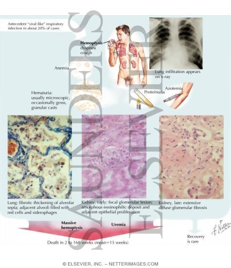 Watermarked preview of labeled image: Lung Purpura With Nephritis (Goodpasture's Syndrome)
