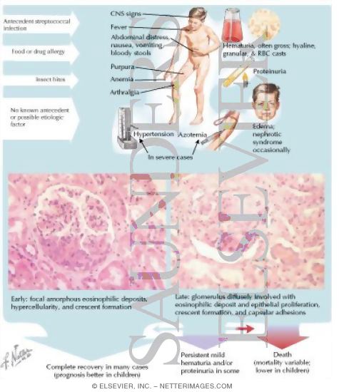 Watermarked preview of labeled image: Nephropathy In Anaphylactoid Purpura (Henoch-Sch&ouml;nlein Disease)