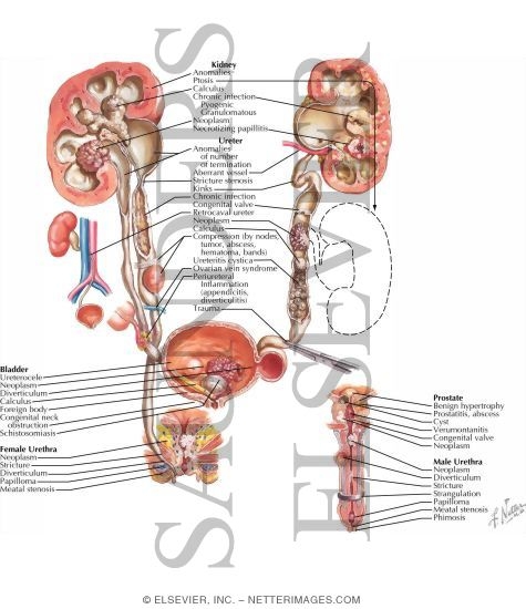 Obstructive Uropathy: Etiology