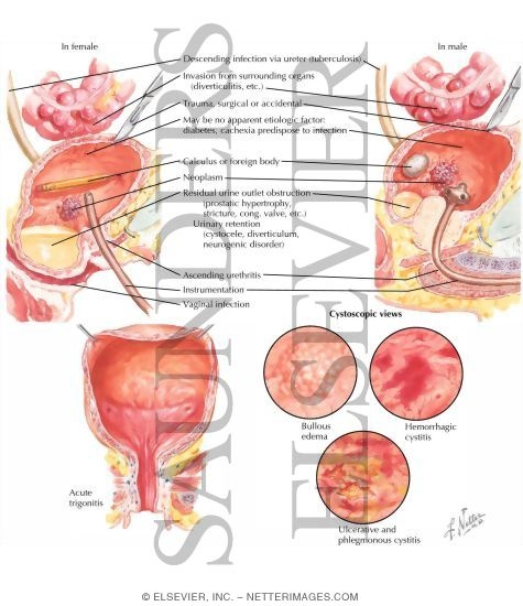Watermarked preview of labeled image: Factors in Etiology of Cystitis