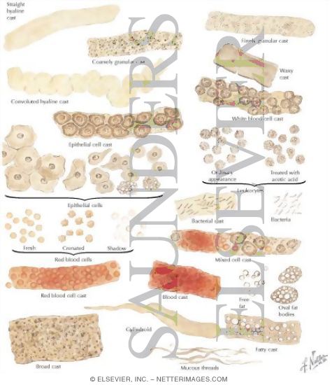 Urinary Sediment: Organized Elements