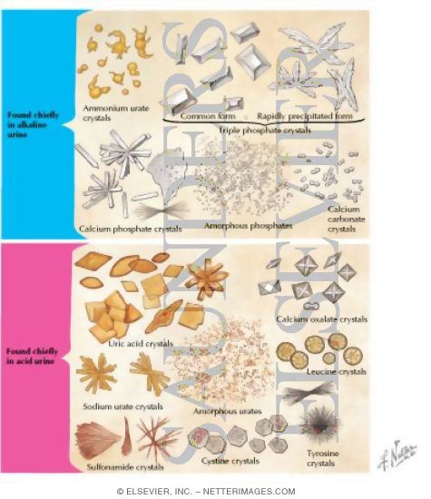 Watermarked preview of labeled image: Unorganized Elements Which May Be Found In Urinary Sediment