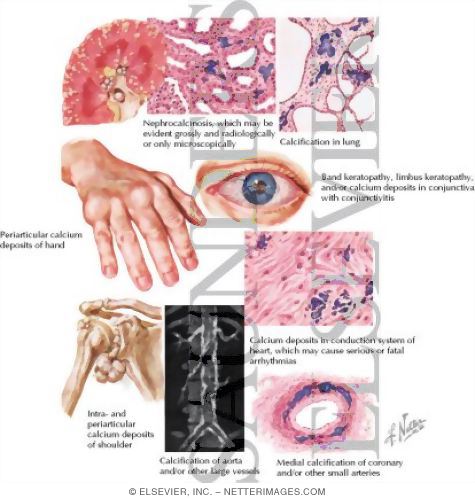 Watermarked preview of labeled image: Tissue Calcification