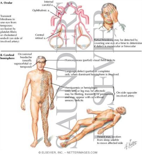 Watermarked preview of labeled image: Clinical Manifestations of Internal Carotid Artery Territory Ischemia