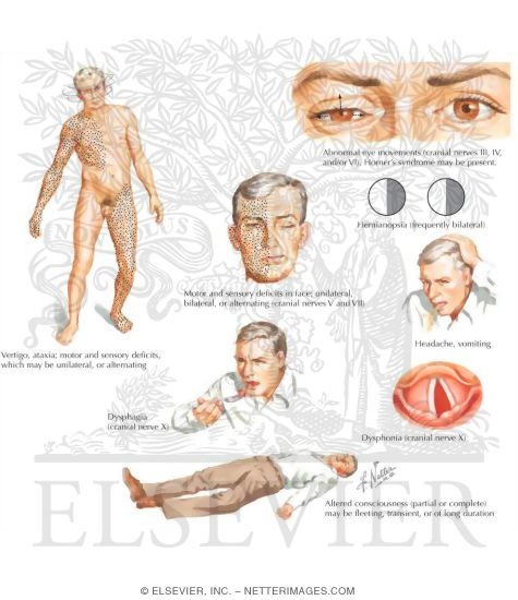 Watermarked preview of labeled image: Clinical Manifestations of Vertebrobasilar Territory Ischemia