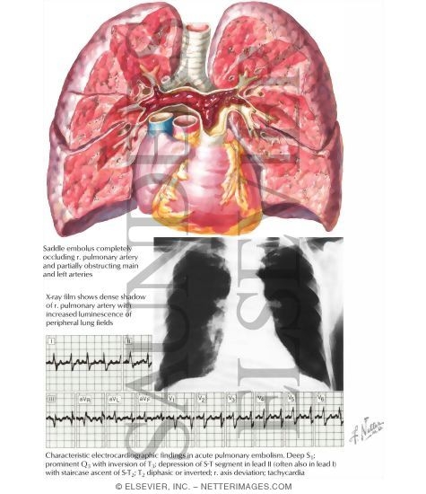 Massive Embolization