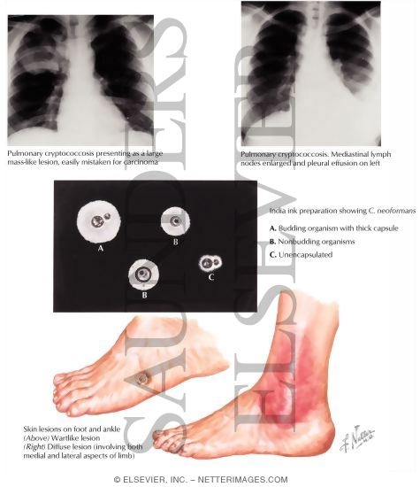 Watermarked preview of labeled image: Cryptococcosis (Torulosis)