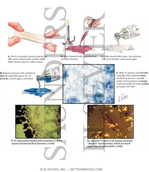 Tuberculosis: Sputum Examination (Stained Smear)