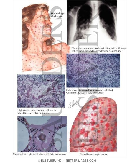 Watermarked preview of labeled image: Varicella Pneumonia