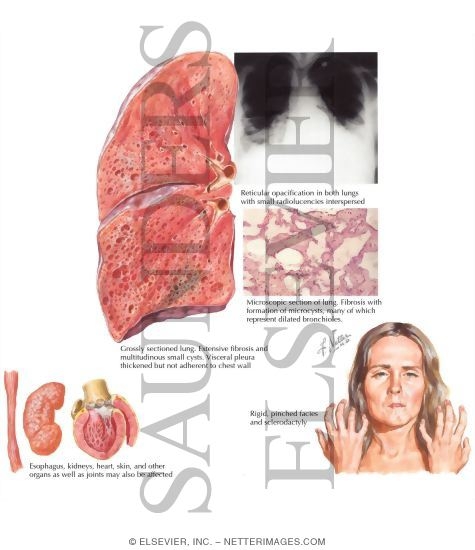 Progressive Systemic Sclerosis (PSS; Scleroderma); Lung Involvement