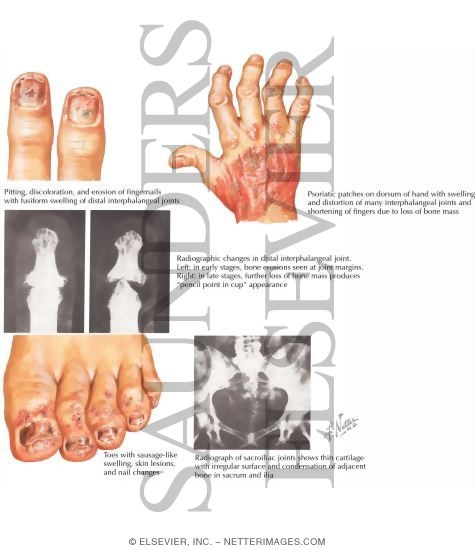 Watermarked preview of labeled image: Psoriatic Arthritis