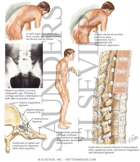 Ankylosing Spondylitis