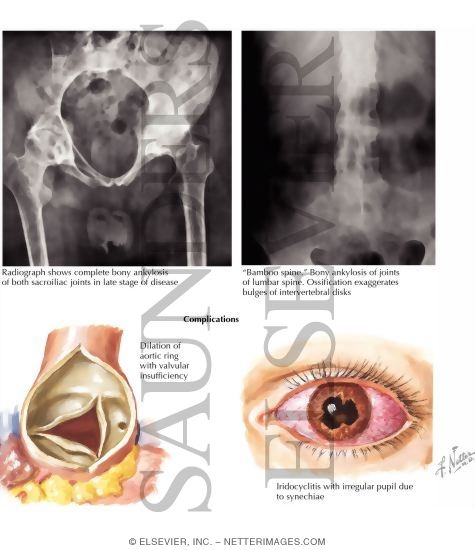 Ankylosing Spondylitis