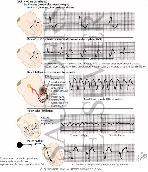 Ventricular Rhythms