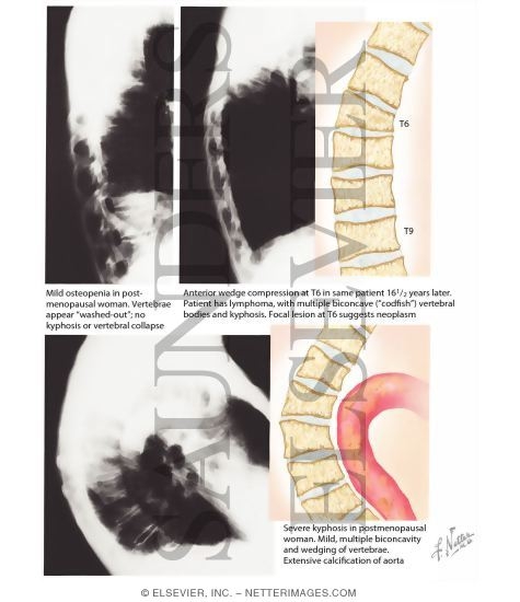 Watermarked preview of labeled image: Clinical Manifestations of Osteoporotic Vertebral Compression Fractures