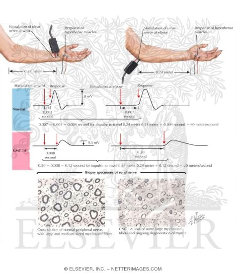 Hereditary Motor-Sensory Neuropathy Type I: Motor Nerve Conduction Velocity