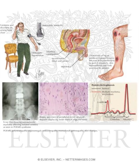 Dysproteinemia (Amyloid Neuropathy)