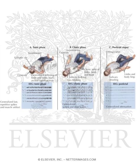 Generalized Tonic-Clonic Seizures