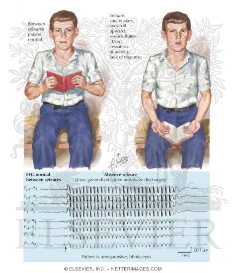 Absence (Petit Mal) Seizures