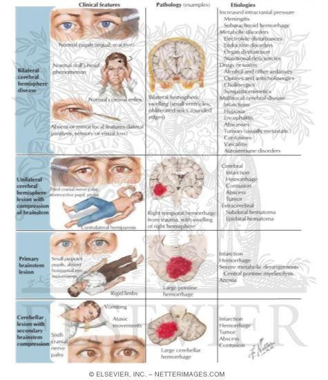 Differential Diagnosis of Coma