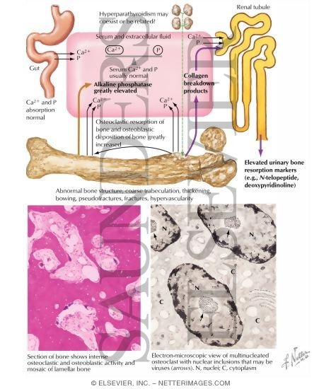 Watermarked preview of labeled image: Pathogenesis and Treatment of Paget's Disease of the Bone