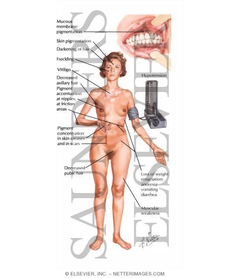 Chronic Primary Adrenal Cortical Insufficiency (Addison's Diseases)