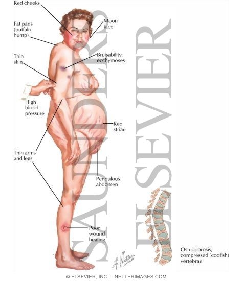 Watermarked preview of labeled image: Cushing's Syndrome: Clinical Findings