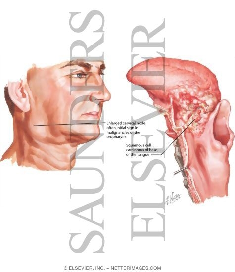 Watermarked preview of labeled image: Malignant Tumors of Oropharynx