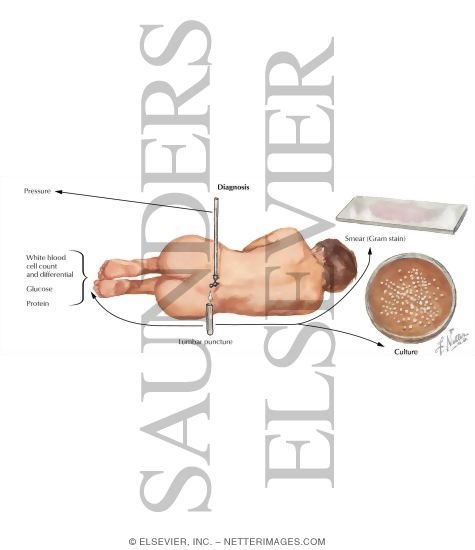 Bacterial Meningitis